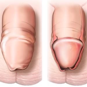 முன் தோல் இன்னும் திறக்கல