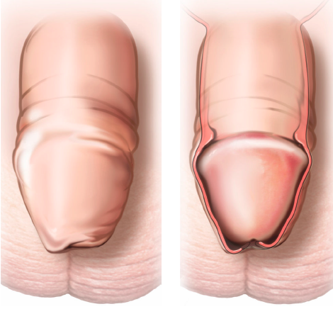 முன் தோல் இன்னும் திறக்கல